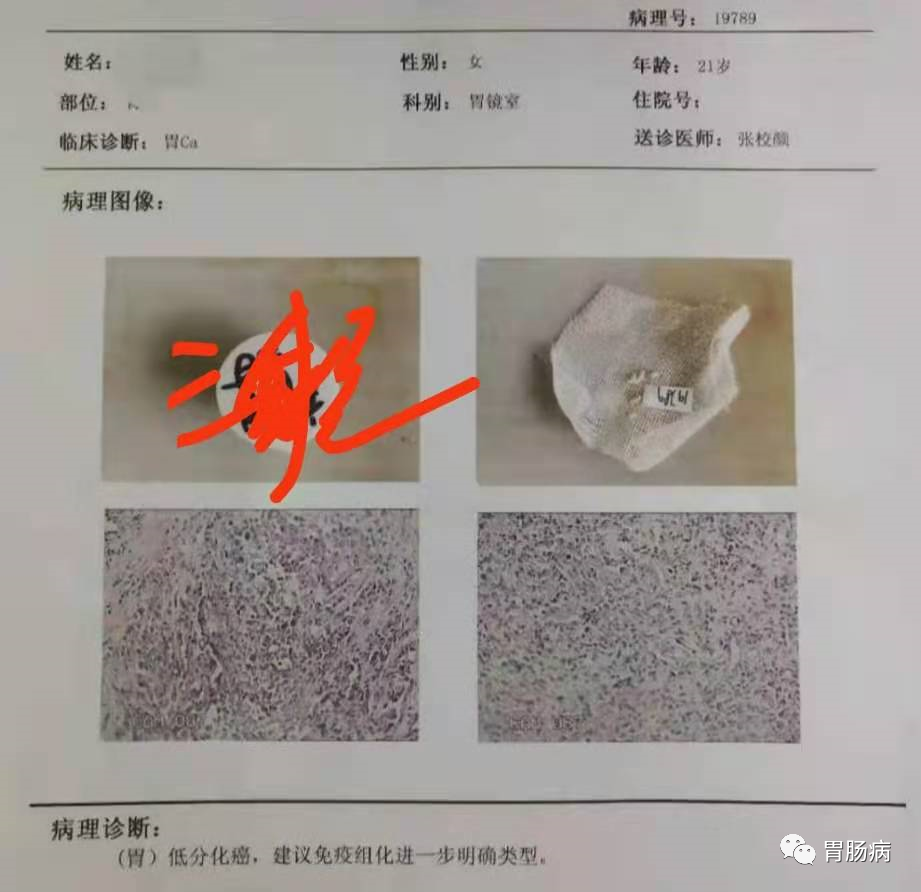 医生总结了3位年轻胃癌患者的病例：30岁不到的他们到底干啥了？